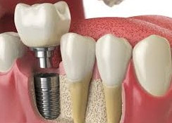 Parafuso de implante dentario