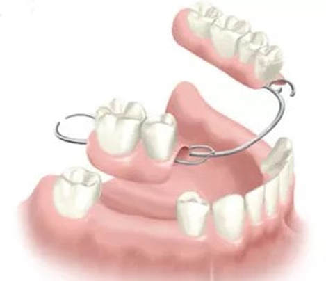 ilustracao protese dentaria parcial